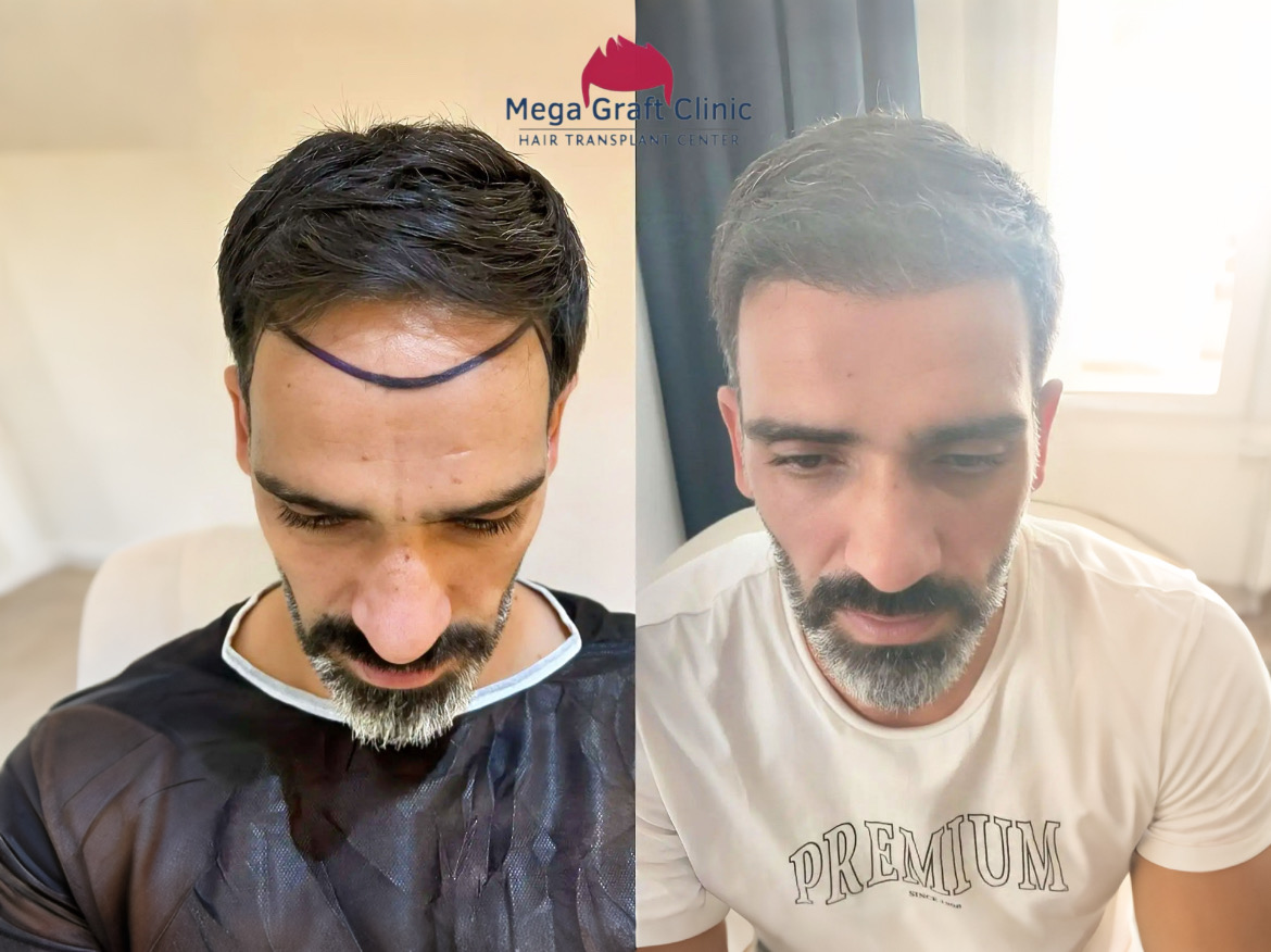 Before and after hair transplant result 1