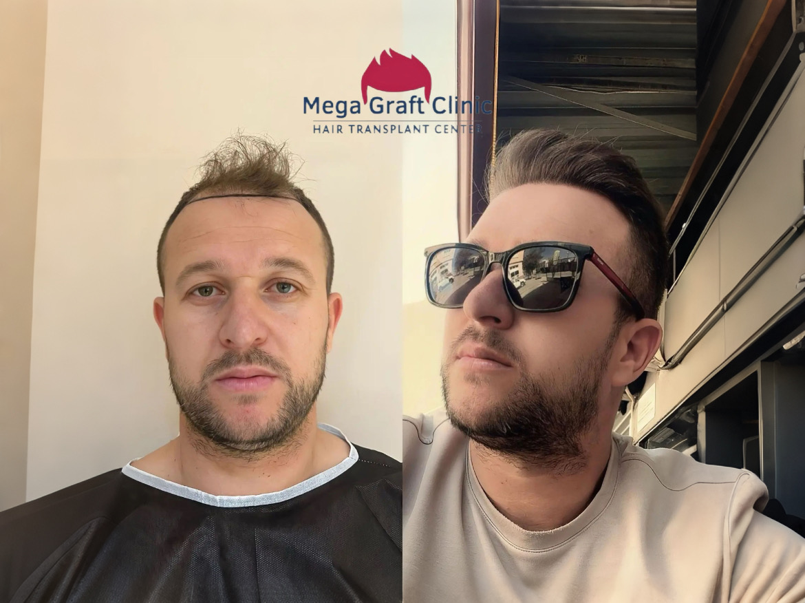 Before and after hair transplant result 5