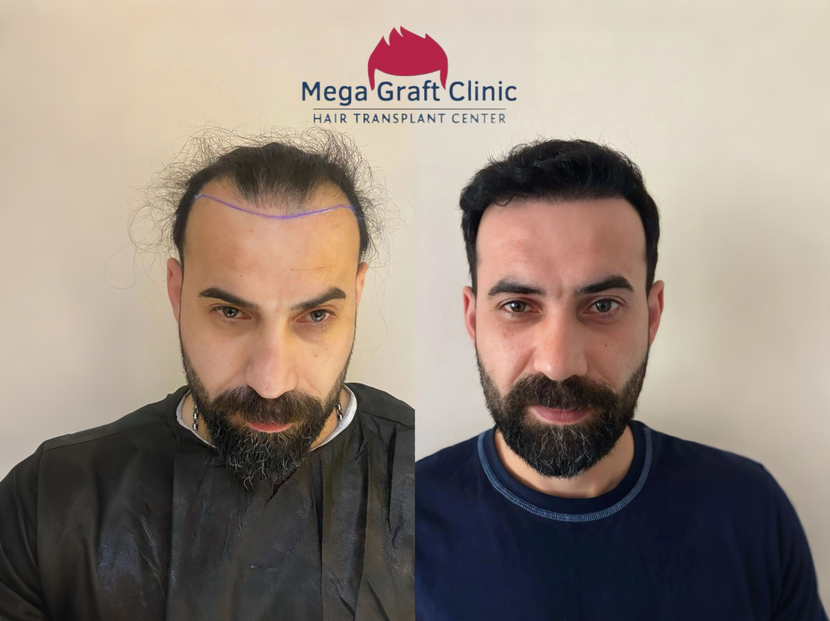 Before and after hair transplant result 12